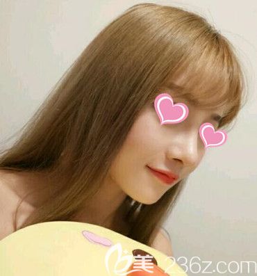 在锦州斯美诺做鼻综合术后90天效果 在锦州斯美诺做鼻综合术后90天效果