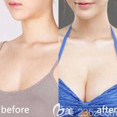 许田海医生隆胸前后对比照