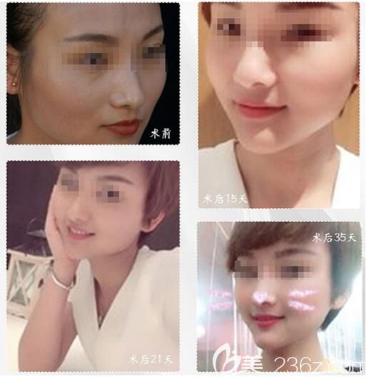 朱志杰医生自体脂肪填充对比案例