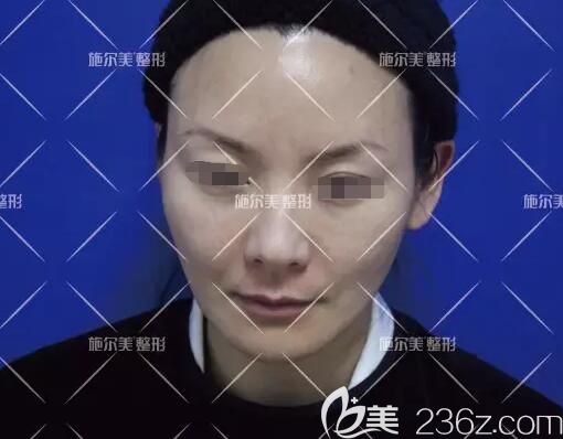 术前面诊面部松弛下垂皱纹明显