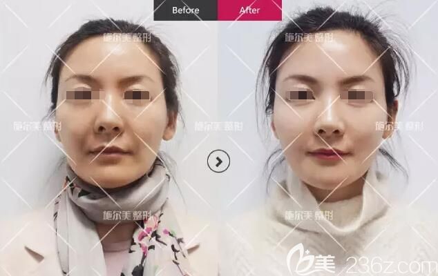 在常州施尔美做完线雕术前术后对比效果