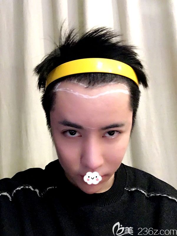 韩国凯伦秀整形医院额头缩小术前设计 韩国凯伦秀整形医院额头缩小术前设计