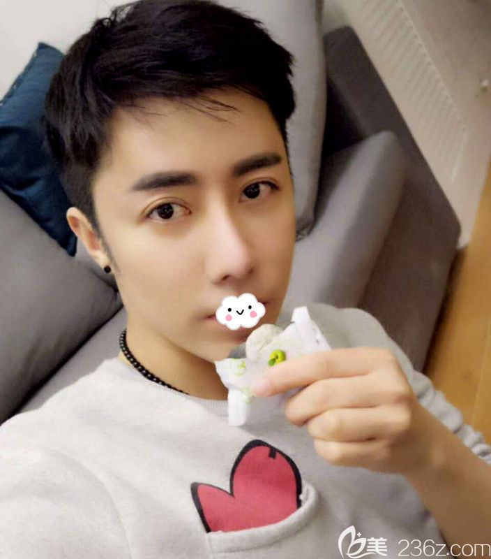 额头发际线太高怎么办?不想做植发到韩国凯伦秀额头缩小术后半年恢复效果图