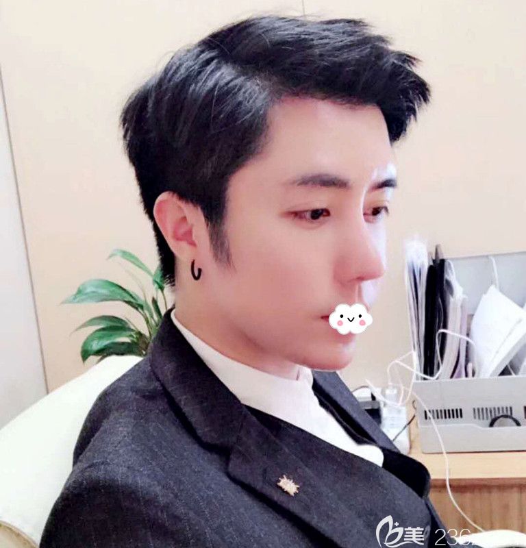 不做发际线种植到韩国凯伦秀做额头缩小术后半年恢复效果图 不做发际线种植到韩国凯伦秀做额头缩小术后半年恢复效果图