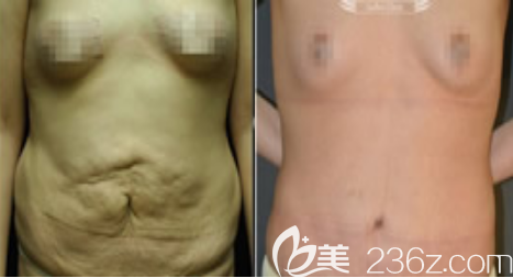 韩国德社罗伊消除妊娠纹图片前后效果对比