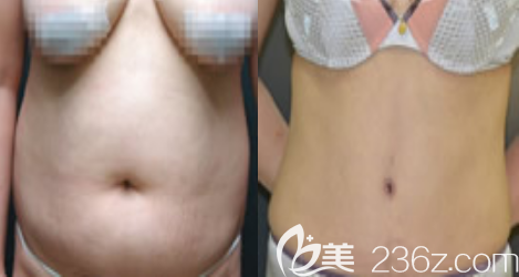 韩国德社罗伊徐云泳吸脂真人案例