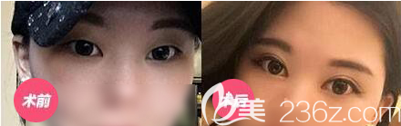 南充五星整形美容医院双眼皮开眼角案例