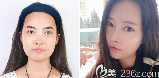 南充韩美整形医院自体脂肪面部填充案例