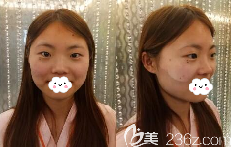 在南充华美名媛做双眼皮隆鼻前的照片 在南充华美名媛做双眼皮隆鼻前的照片