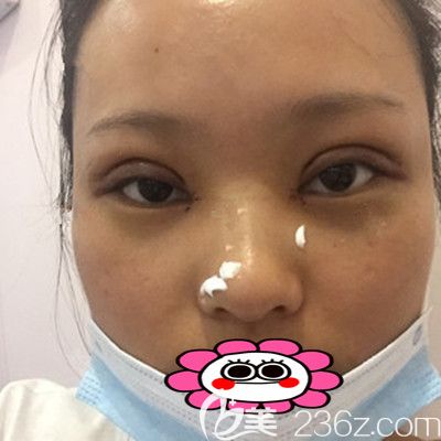 术后第8天，刚拆过线的照片