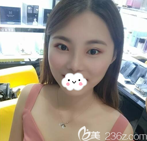 塌鼻子眼无神的我选择在南充华美名媛做双眼皮和综合隆鼻的真实心理路程和恢复效果