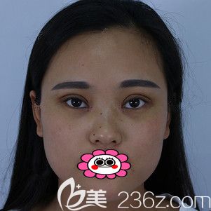 双眼皮手术20天恢复图