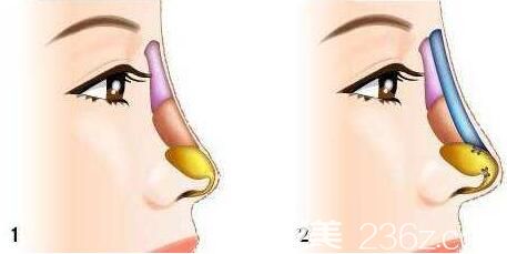 隆鼻取出假体后鼻子跟以前一样吗? 隆鼻取出假体后鼻子跟以前一样吗?