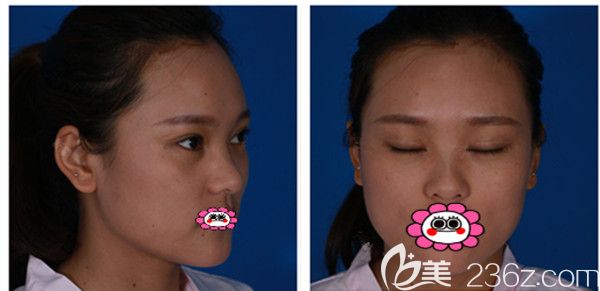 全切双眼皮1个月半过程图