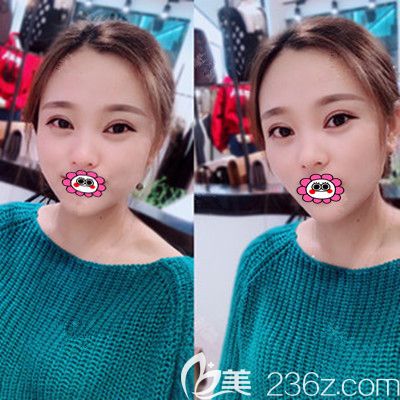 被常德伊丽莎白双眼皮案例种草了，半年前让卢开锐给我割了双眼皮