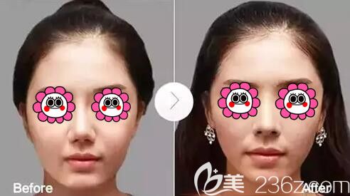 隆鼻假体取出真人案例对比 隆鼻假体取出真人案例对比