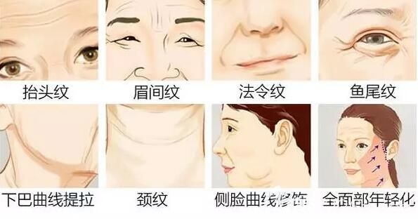 埋线提升可以改善的皮肤状态 埋线提升可以改善的皮肤状态