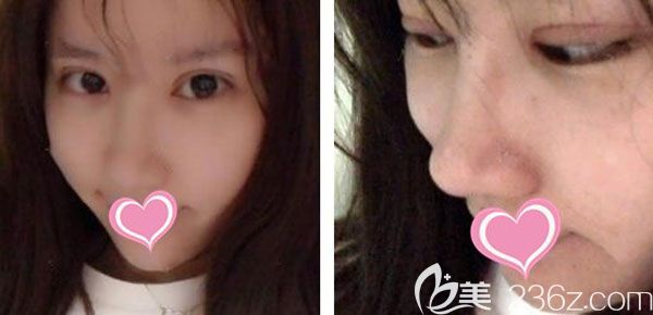 肋软骨假体隆鼻第7天鼻小柱和鼻孔里的线都拆掉了