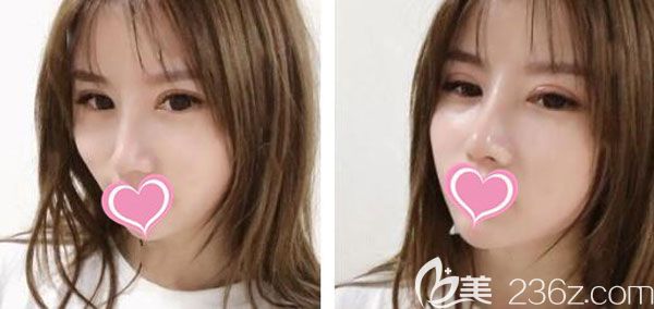 隆鼻术后第20天山根和鼻头都不肿了