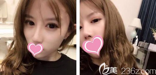 肋软骨隆鼻手术1个月侧面的线条柔和