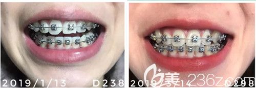 牙齿拥挤不齐在西安诺贝尔口腔带上牙套后一年，迫不及待分享我的矫正“进化史”