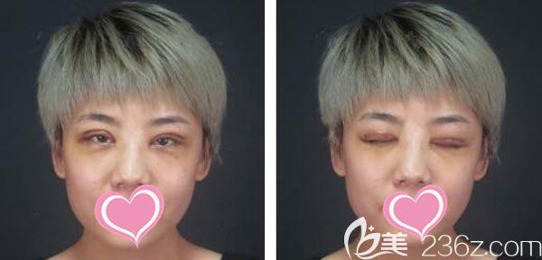 切开双眼皮第7天眼睛线条流畅