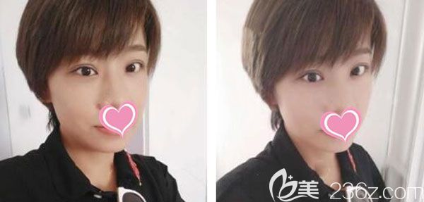 全切双眼皮第20天肿胀和淤青已经消退