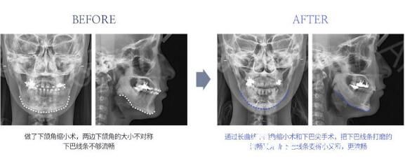 面部轮廓整形术前CT照片