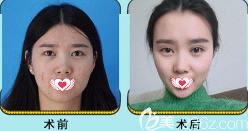 京美整形医院注射瘦脸案例 京美整形医院注射瘦脸案例
