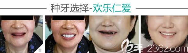 沈阳欢乐口腔全口种植牙案例效果图 沈阳欢乐口腔全口种植牙案例效果图