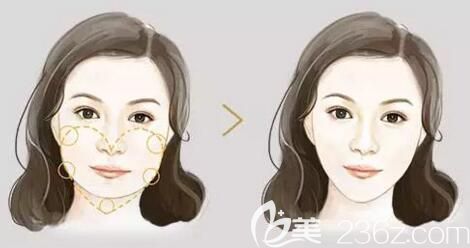 下颌角整形前后效果对比
