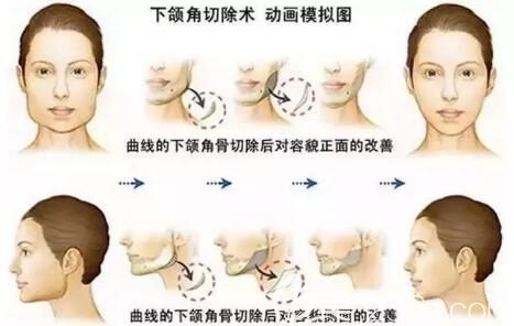 下颌角整形动画模拟图