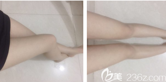 深圳仁安雅大腿吸脂半个月恢复效果