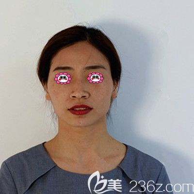 脂肪填充前照片 脂肪填充前照片