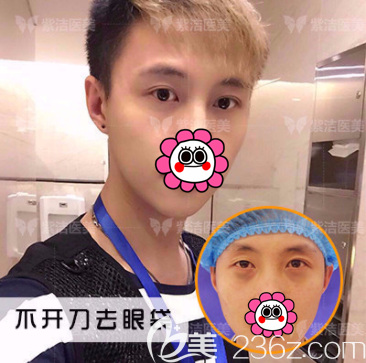 北京紫洁俪方不开刀祛眼袋案例 北京紫洁俪方不开刀祛眼袋案例