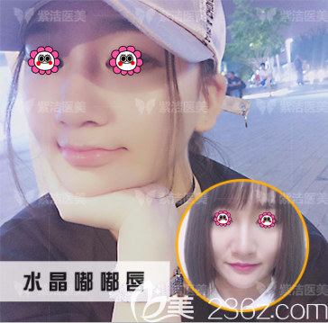 北京紫洁医美注射丰唇案例 北京紫洁医美注射丰唇案例