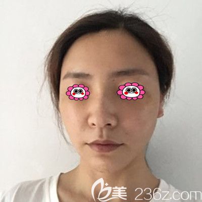 脂肪填充30天恢复照片 脂肪填充30天恢复照片