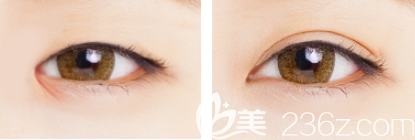 韩国仁川佳颜孙基学韩式无痕双眼皮案例效果对比图 韩国仁川佳颜孙基学韩式无痕双眼皮案例效果对比图