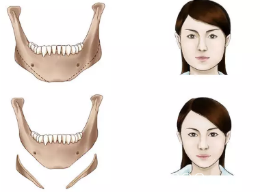 传统下颌角切除示意图