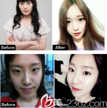 下颌角切除案例