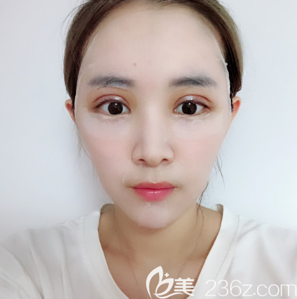 双眼皮术后四天消肿情况 双眼皮术后四天消肿情况