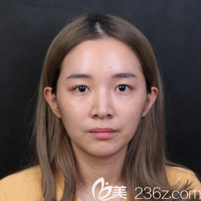 术前单眼皮照片 术前单眼皮照片