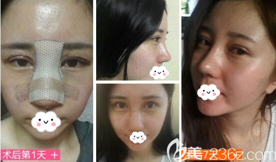 南充华美名媛双眼皮隆鼻术后效果展示