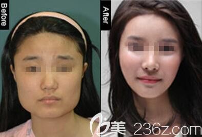 韩国延世真整形外科面部轮廓案例