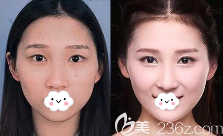 南充阿蓝沙新力双眼皮术前术后对比效果