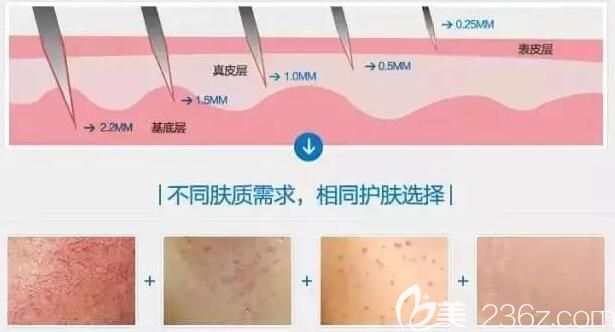 无锡施尔美分享微针美肤原理 无锡施尔美分享微针美肤原理