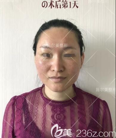 刚做完微针美肤天面部泛红 刚做完微针美肤天面部泛红