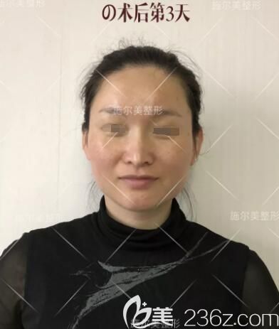 做完微针美肤术后三天恢复 做完微针美肤术后三天恢复