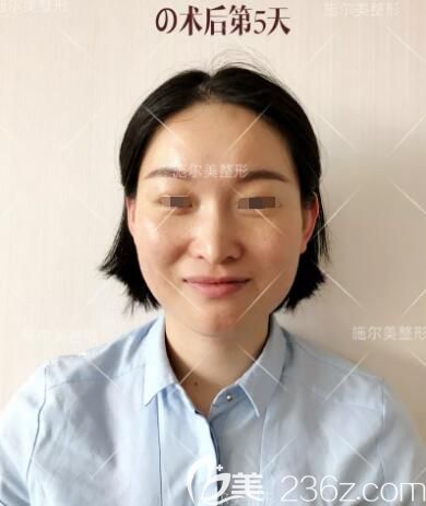 术后五天微针美肤效果展示 术后五天微针美肤效果展示