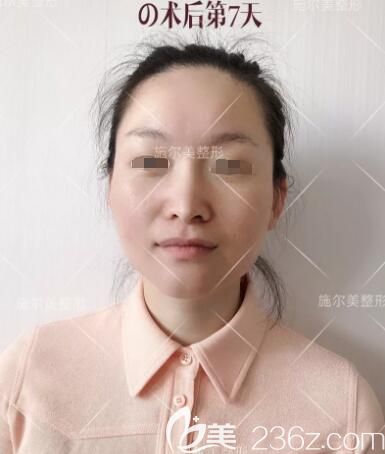 孙华医生分享术后一周微针美肤分享 孙华医生分享术后一周微针美肤分享